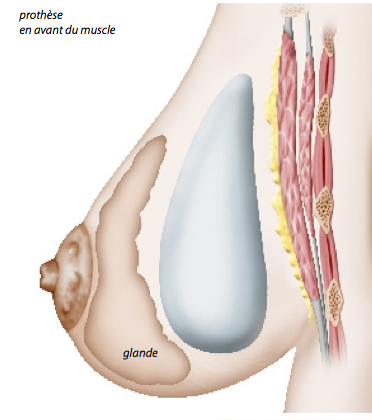 Chirurgie des seins par prothèse - Paris -docteur Ozil