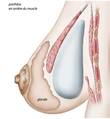 Chirurgie des seins par prothèse - Paris 6-docteur Ozil