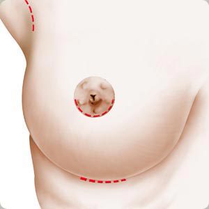 Chirurgie esthetique des seins - Paris - docteur Ozil