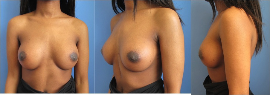 Chirurgie esthétique des seins - Paris