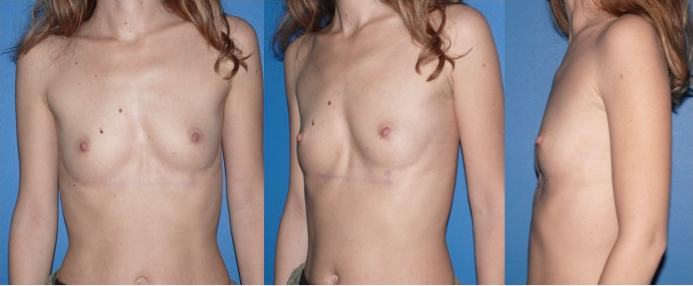 Chirurgie esthétique des seins - Paris