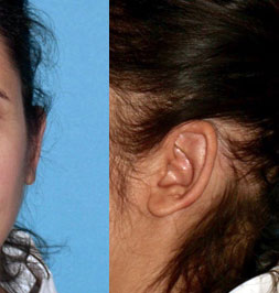 After-Otoplastie ou chirurgie esthétique des oreilles