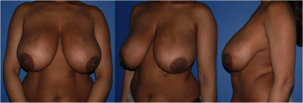 Chirurgie du sein à Paris : réduction mammaire - Dr Ozil