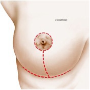 Réduction mammaire à Paris - Dr Ozil